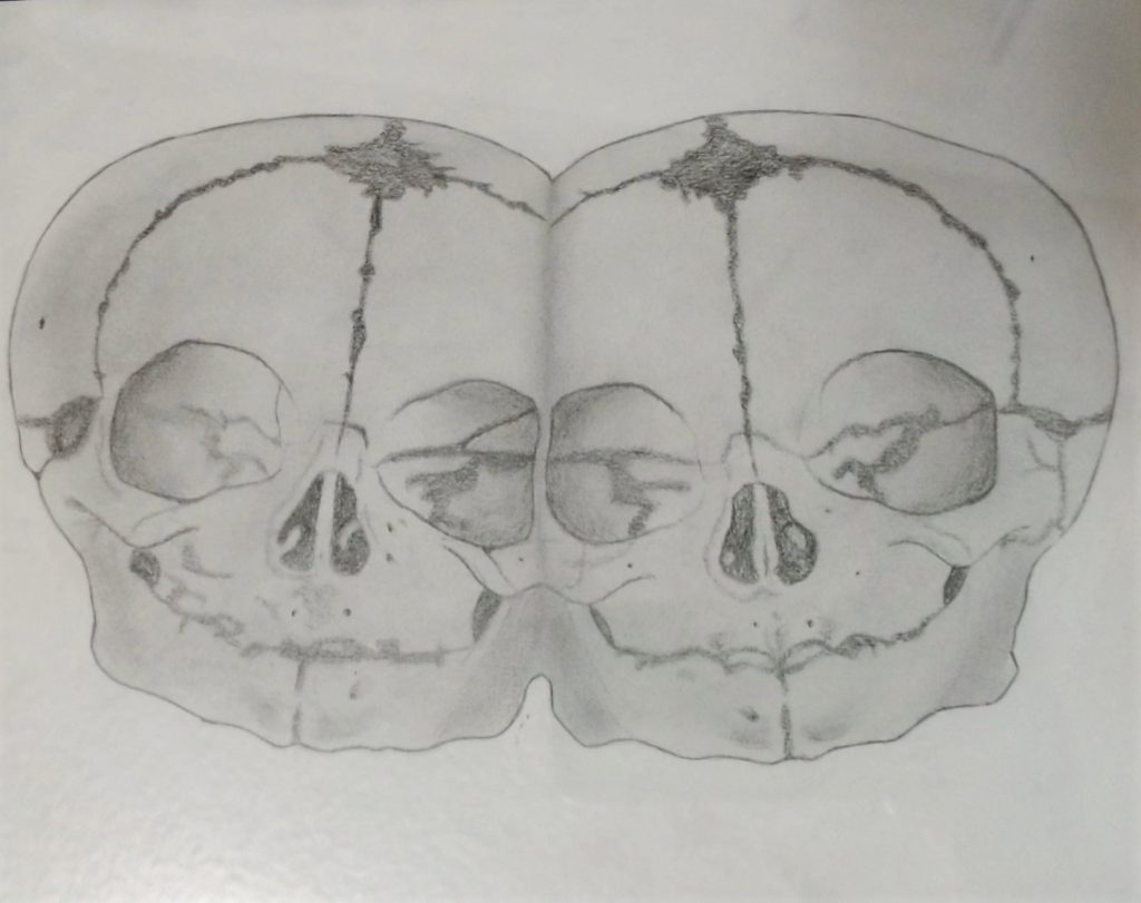 Conjoined skulls for an art class